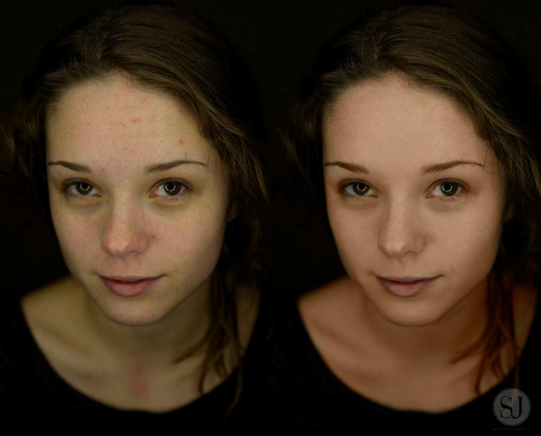 Before and After - Model: Julia T.