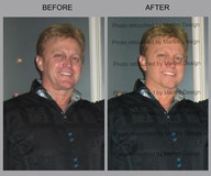 Facial Retouch