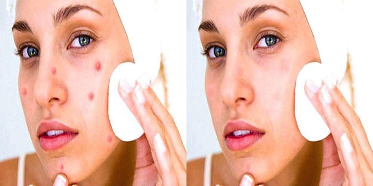 pimple remove