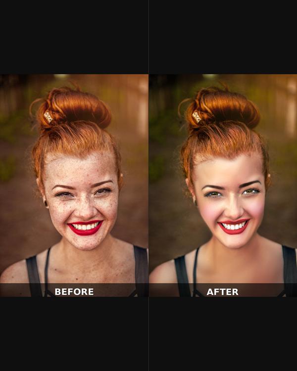 before after freckle removal