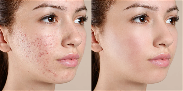 smooth skin1k